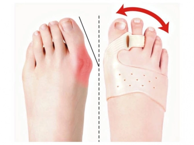 Ločevalec prstov za hallux valgus z magnetom